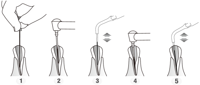 Сфера применения наконечника для скалера